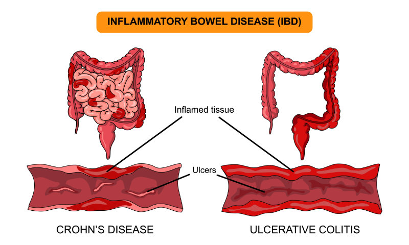 graphic with labeled parts of inflammatory bowel disease