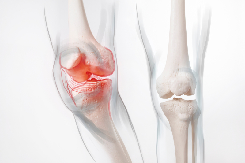 x-ray image showing knee inflammation in joint