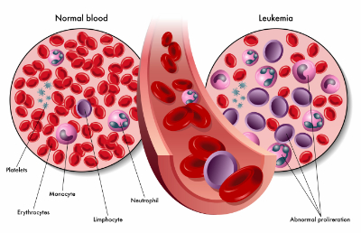 leukemia_in_blood