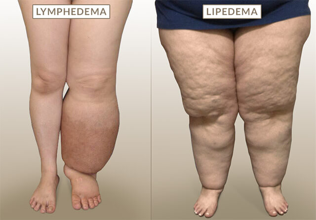 lymphedema-vs-lipedema.jpg