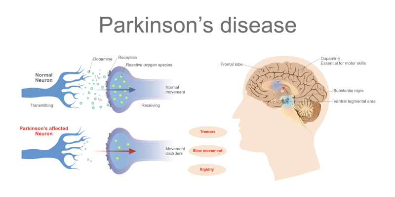 parkinsons_dopamine_levels