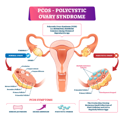 boards and beyond videos on pcos