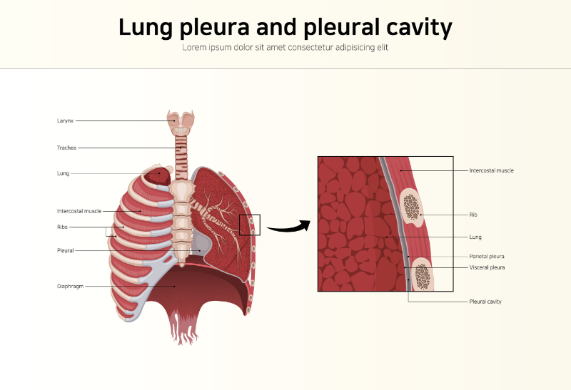 spontaneous pneumothorax tracheal deviation