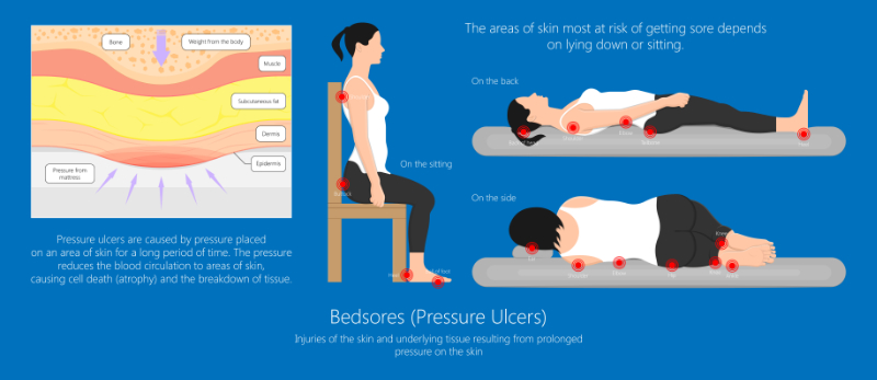 graphic showing different pressure point positions