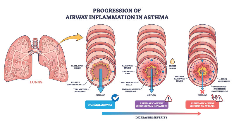graphic showing progression of airway inflammation in asthma