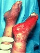 photo of sock burns on childs feet