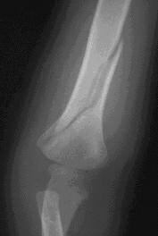 xray of spiral fracture