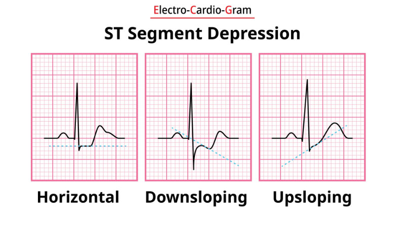 graphic showing st depression forms