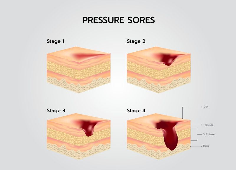 graphic showing stages of pressure sores