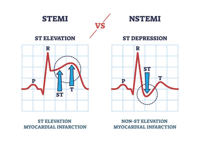 graphic showing stemi vs nstemi