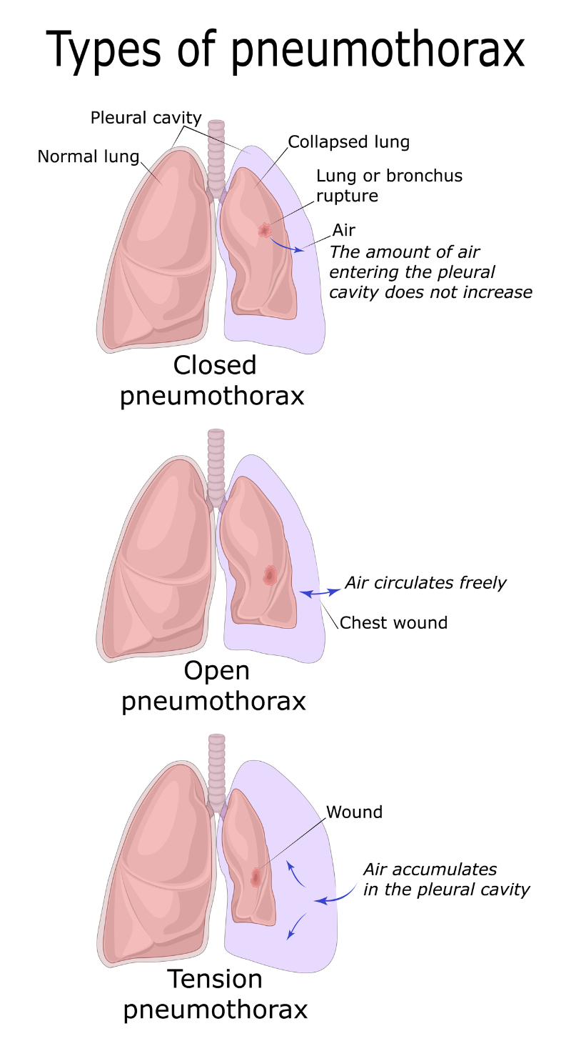 types_of_pneumothorax