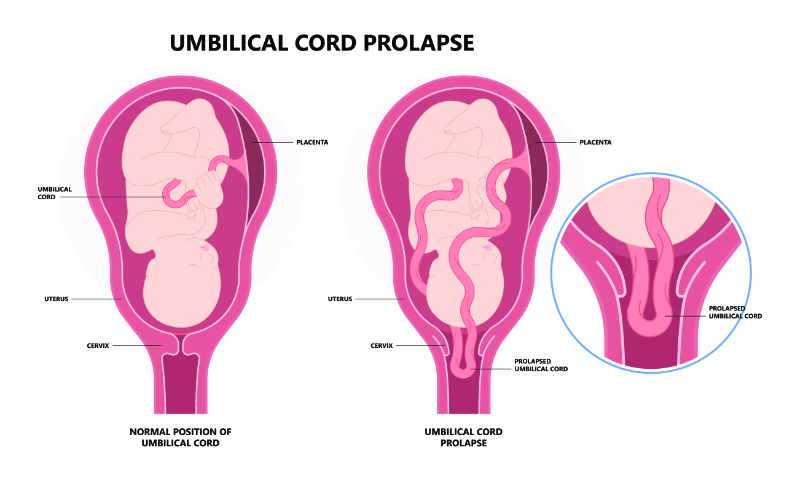 graphic showing umbilical cord prolapse