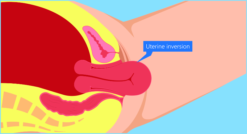 graphic showing uterine inversion